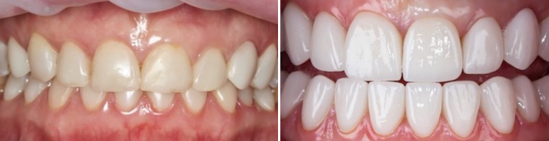 Фото до и после - Прицельный снимок зубов