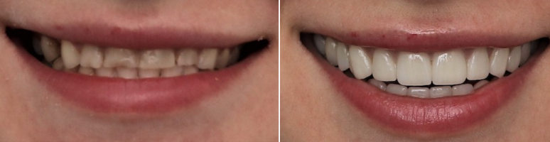 Фото до и после - Профгигиена полости рта