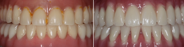 Фото до и после - Лечение пульпита молочных зубов