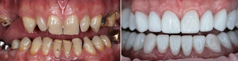 Фото до и после - Удаление зубов пьезоскальпелем