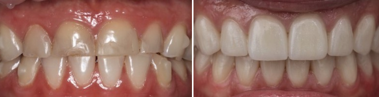 Фото до и после - Вкладки/накладки на зубы