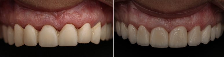 Фото до и после - Профгигиена полости рта