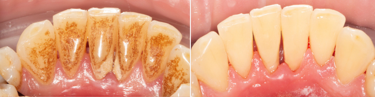 Фото до и после - Профгигиена полости рта 